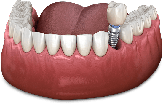 Dental Implants