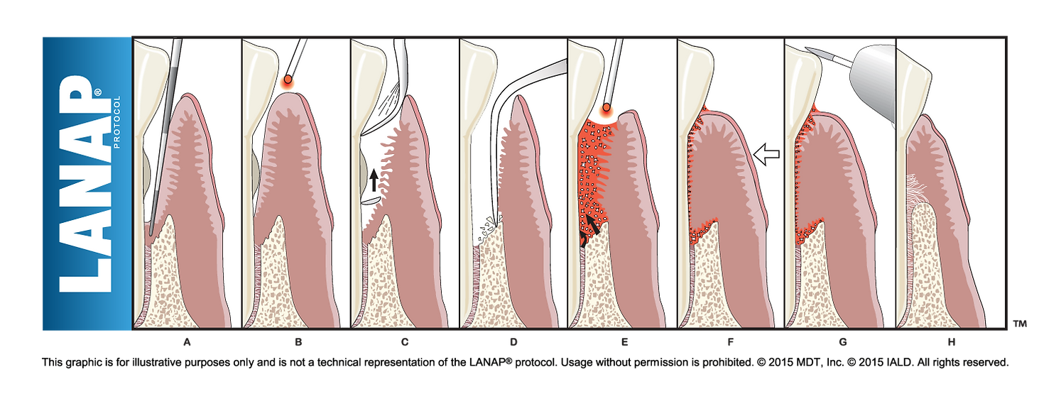 LANAP steps